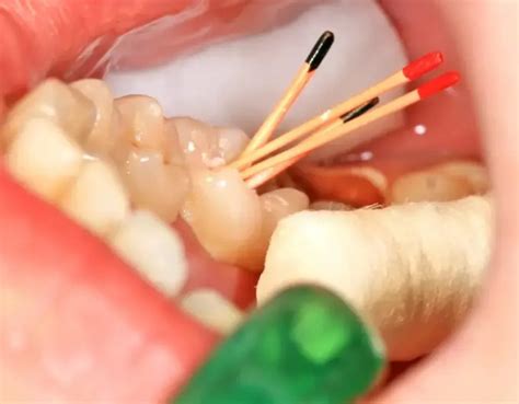 Buy Dentsply Protaper Universal Gutta Percha Points – Oralkart