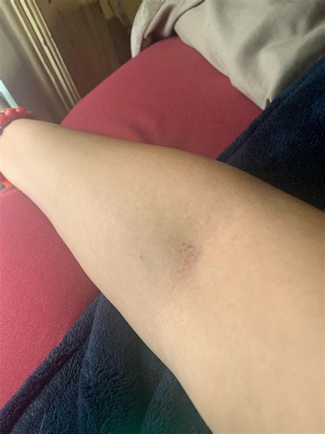 Iv Bruise