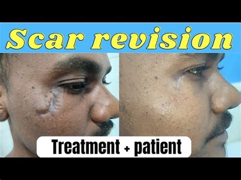 Scar revision surgery - Result after 5 months| Scar revision surgery in ...