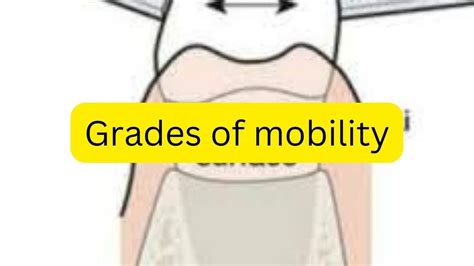 Image result for Tooth Mobility Classification Chart
