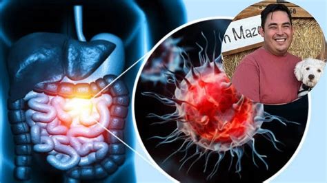 What Is Colon Cancer, Which US Instagram Star Tanner Martin Died Of ...