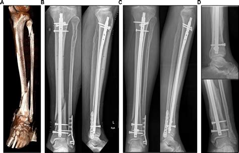 Frontiers | Simulation-based prediction of bone healing and treatment ...