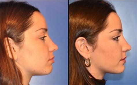 Ortodoncia Borja | En ortodoncia quitar dientes no es un drama es una ...