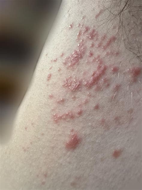 Rash under armpit : r/DermatologyQuestions