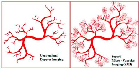 The Promising Role of a Superb Microvascular Imaging Technique in the ...