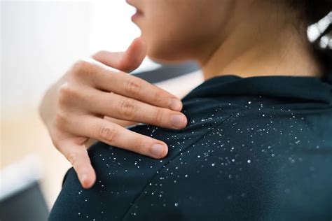 Dandruff Products: Uses, Benefits & How to Pick the Right One | H&S India