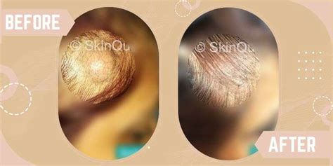Lipoma Treatment in South Delhi, Saket | SkinQure