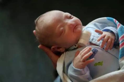 美国男婴一出生就没有鼻子，无鼻人该怎么呼吸？