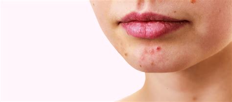 Pustule Acne: What Causes Those Pesky Acne on Your Face | The Pink Foundry