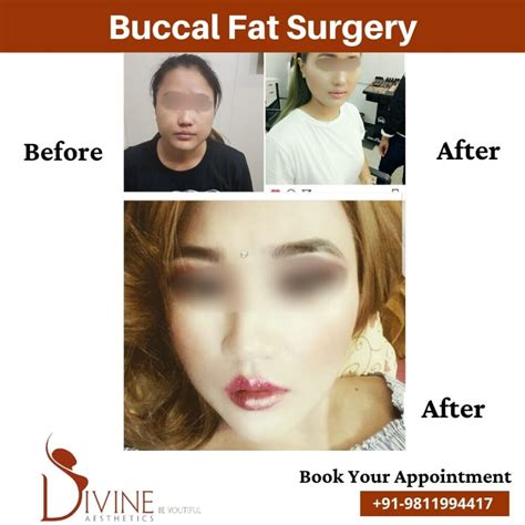Face Fat Removal Surgery Cost India at Victoria Stead blog