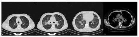 Morphological Patterns of Sarcoidosis and Clinical Outcome ...