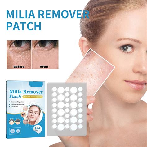 Milia Remover, 144Pcs Overnight Milia & Acne Spot Treatment Treatment Patch with Bentonite Clay ...