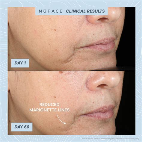 NuFace Neck Tutorial 的图像结果