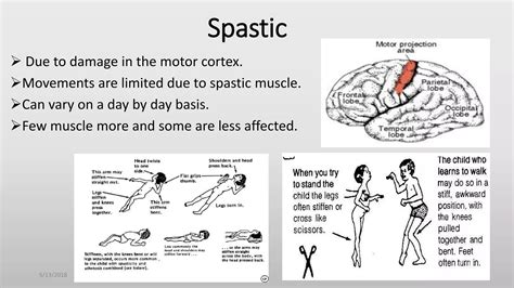 Orthotic treatment for cp patients (ridoy) | PPTX