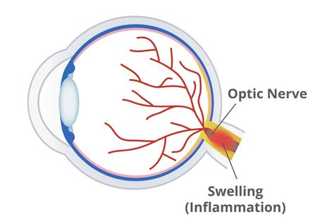 What Are Optic Nerve Drusen and How Do They Affect Vision?