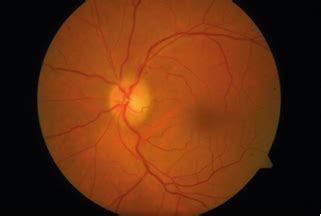 Immunomodulation with Mycophenolate Mofetil (MMF) for Anti-Myelin ...