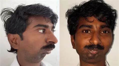 Indian Man’s Jaw-Deformity Photo Turns Racist Meme; Mocked As 'Job ...