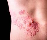 Warning Signs of Shingles | Things Health