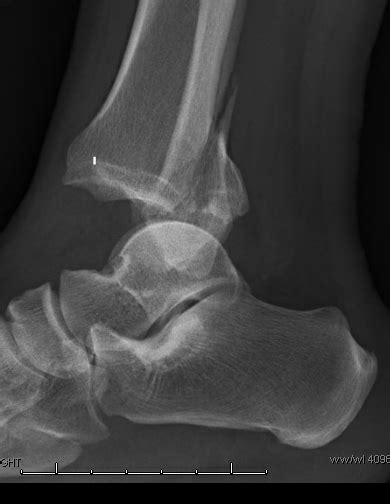 irreducible trimalleolar fracture | The Foot and Ankle Online Journal