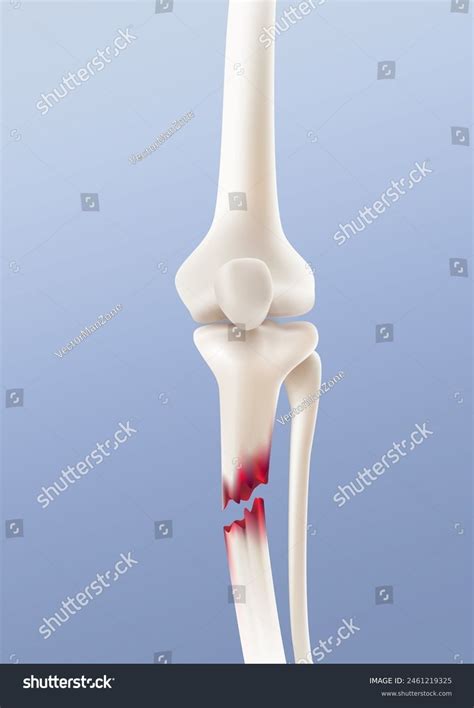 Close-up Image Broken Leg Bone Realistic Stock Vector (Royalty Free) 2461219325 | Shutterstock