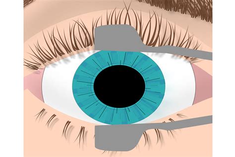 Refractive surgery : Ratnam Superspeciality Eye Hospital Rajajipuram ...