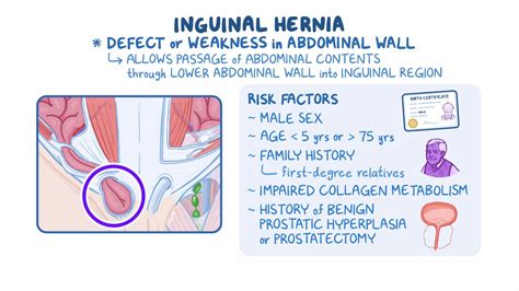 Direct Hernia Male Physical Findings Inguinal Hernias: Types, Causes