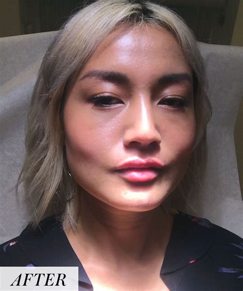 Bad Lip Injections Before And After