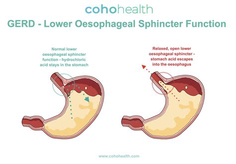 The Functional Medicine approach to GERD: feel better faster