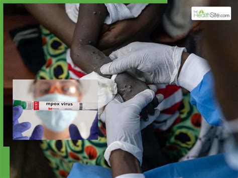 Clade Ib Mpox Cases Surge Worldwide, WHO Issues High Alert: 17 Deaths ...