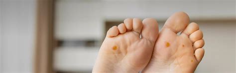 Corn Removal at Skin Secrets Kochi