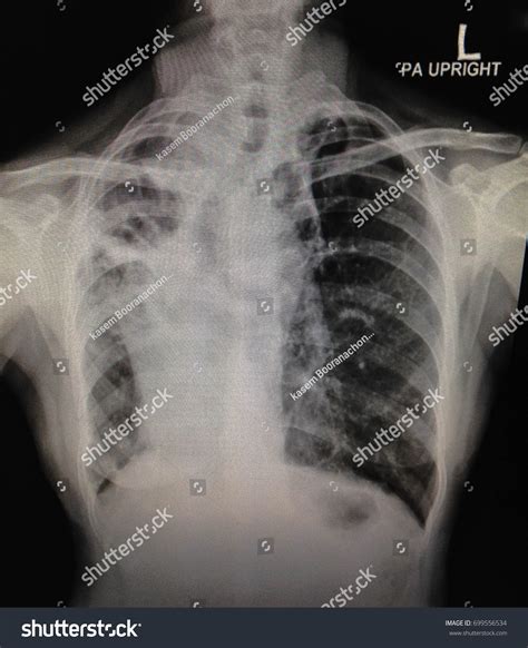Chest X Ray Identification/abnormal Chest X Ray Images