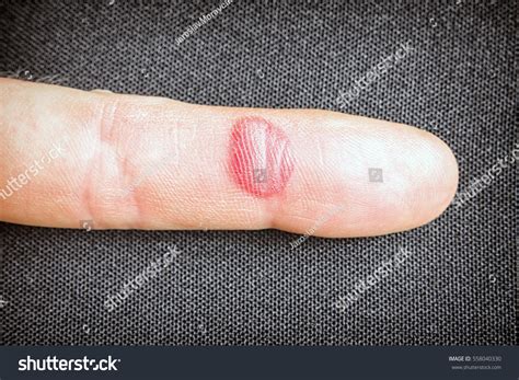 Bloody Abrasion On Finger Red Bruise Stock Photo 558040330 | Shutterstock