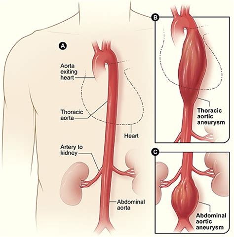 Iliac Artery - Common iliac artery, Internal & External iliac artery branches