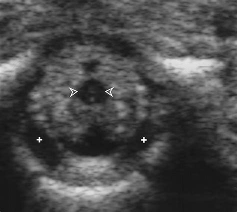Cerebrospinal Fluid Leakage After Lumbar Puncture in Neonates ...