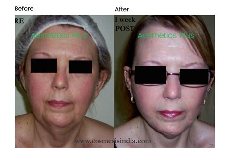 Facelift Surgery in Bangalore - Aesthetic Plus | Cosmetic surgeries ...