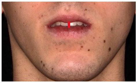 Evaluation of Incisor Position in a Sample of Orthodontic Patients