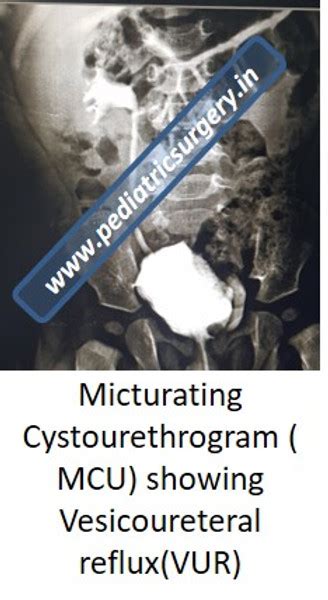 Micturating Cystourethrogram ( MCU) | pediatricsurgery.in