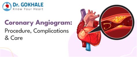 Coronary Angiogram Procedure 的图像结果