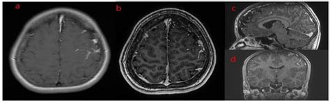 Encephalocraniocutaneous Lipomatosis, a Radiological Challenge: Two ...