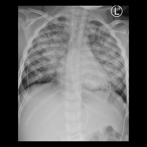 Pediatric Pulmonary Edema | Pediatric Radiology Reference Article | Pediatric Imaging | @pedsimaging