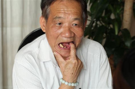 怎么预防老年人掉牙——广州德伦口腔