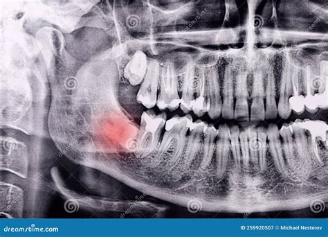 Horizontal Inflamed Wisdom Tooth on Panoramic Dental Tooth X-ray Examination Stock Image - Image ...