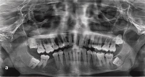 Wisdom Tooth Cyst Removal 的图像结果