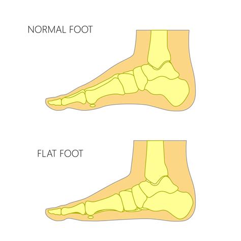 Flat Feet In Children: What Are They And Should You Be Worried?