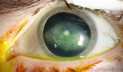 Atlas Entry - Riley-Day Syndrome (Familial Dysautonomia) with ...