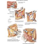 Image result for Flank Incision Nephrectomy