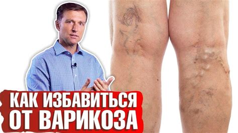 Причины, симптомы и эффективные методы лечения варикоза