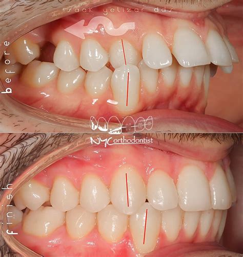 Image result for Crossbite Treatment Options
