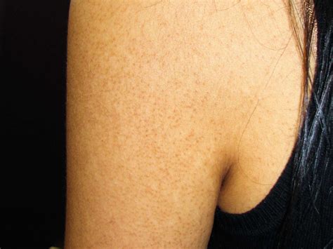 Keratosis Pilaris: Types, Symptoms, Causes, Treatment