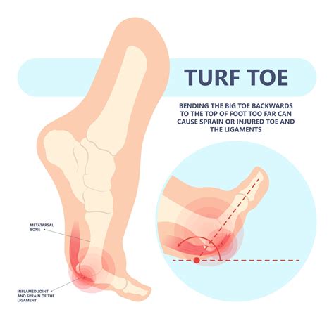 Turf Toe Symptoms